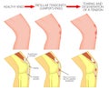 Knee joint problem_Patellar tendonitis or jumper knee. Progress