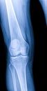 Knee joint x-ray (AP and LATERAL) view fracture and displacement of the patella bone or knee cap