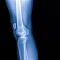 Knee joint x-ray (AP and LATERAL) view fracture and displacement of the patella bone or knee cap
