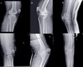 Knee joint x-ray collection fracture different views Royalty Free Stock Photo