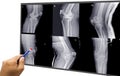 Knee joint x-ray collection fracture different views Royalty Free Stock Photo