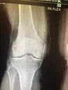 Knee joint x-ray image