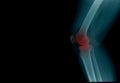 Knee joint x-ray image Royalty Free Stock Photo