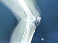 Knee joint x-ray views Fracture tibial eminence is suspected. Left knee joint fluid is seen