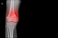 Knee joint x-ray showing fracture distal femur on red mark.and black background