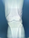 Knee joint x-ray views Fracture tibial eminence is suspected. Left knee joint fluid is seen