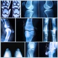 Knee medical exam: X-ray and MRI scan Royalty Free Stock Photo