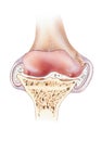 Knee - Moderate Osteoarthritis, Cutaway