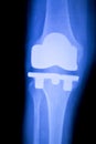 Knee orthopedic implant xray scan Royalty Free Stock Photo