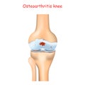 Knee Osteoarthritis. Arthritis or joint pain Royalty Free Stock Photo