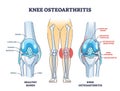 Knee osteoarthritis condition with skeletal bone degeneration outline diagram