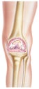 Knee - Osteoarthritis of the joint