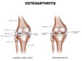 Knee Osteoarthritis Royalty Free Stock Photo