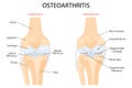 Knee Osteoarthritis and normal joint detailed anatomy. Osteoarthritis. Arthritis or pain within a joint. degenerative joint