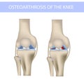 Knee osteoarthritis, realistic medical vector illustration
