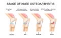 Knee Osteoarthritis Stages Royalty Free Stock Photo