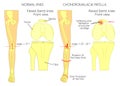 Knee Pain and chondromalacia patella