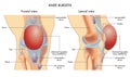 Knee pain 