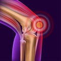 Knee pain. Trauma to the leg, patella, knee joint.