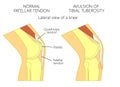 Knee problem_Avulsion of tibial tuberosity