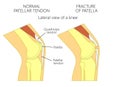 Knee problem_Fracture of patella