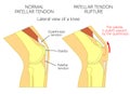 Knee problem_Patellar tendon rupture Royalty Free Stock Photo