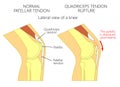 Knee problem_Quadriceps tendon rupture Royalty Free Stock Photo