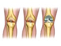 Knee replacement Royalty Free Stock Photo