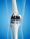 A knee replacement