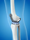 a knee replacement