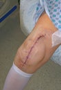Knee replacement surgery scar