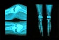 knee replacement xray Royalty Free Stock Photo