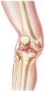 Knee - Rheumatoid Arthritis