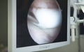 Knee surgery operation screen