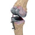 Knee and titanium hinge joint.