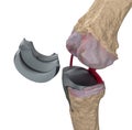 Knee and titanium hinge joint.