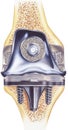 Knee - Total Replacement - Showing Cutaway View of Implant