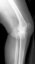 Knee x-ray Royalty Free Stock Photo