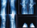 Knee x-ray