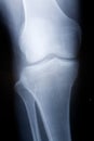 Knee x-ray image Royalty Free Stock Photo