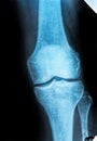 Knee X-ray Royalty Free Stock Photo