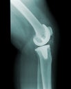 Knee x-ray with joint replacement