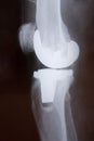 Knee x-ray picture Royalty Free Stock Photo