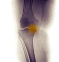 Knee X-ray, severe degenerative osteoarthritis