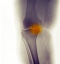 Knee X-ray, severe degenerative osteoarthritis