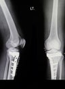 Knee x-rays image Royalty Free Stock Photo