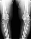 Knee x-rays image showing plate and fixation Royalty Free Stock Photo