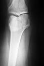 Knee Xray