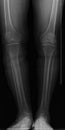 Knee xray image