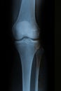 Knee Xray with 4 visible bones